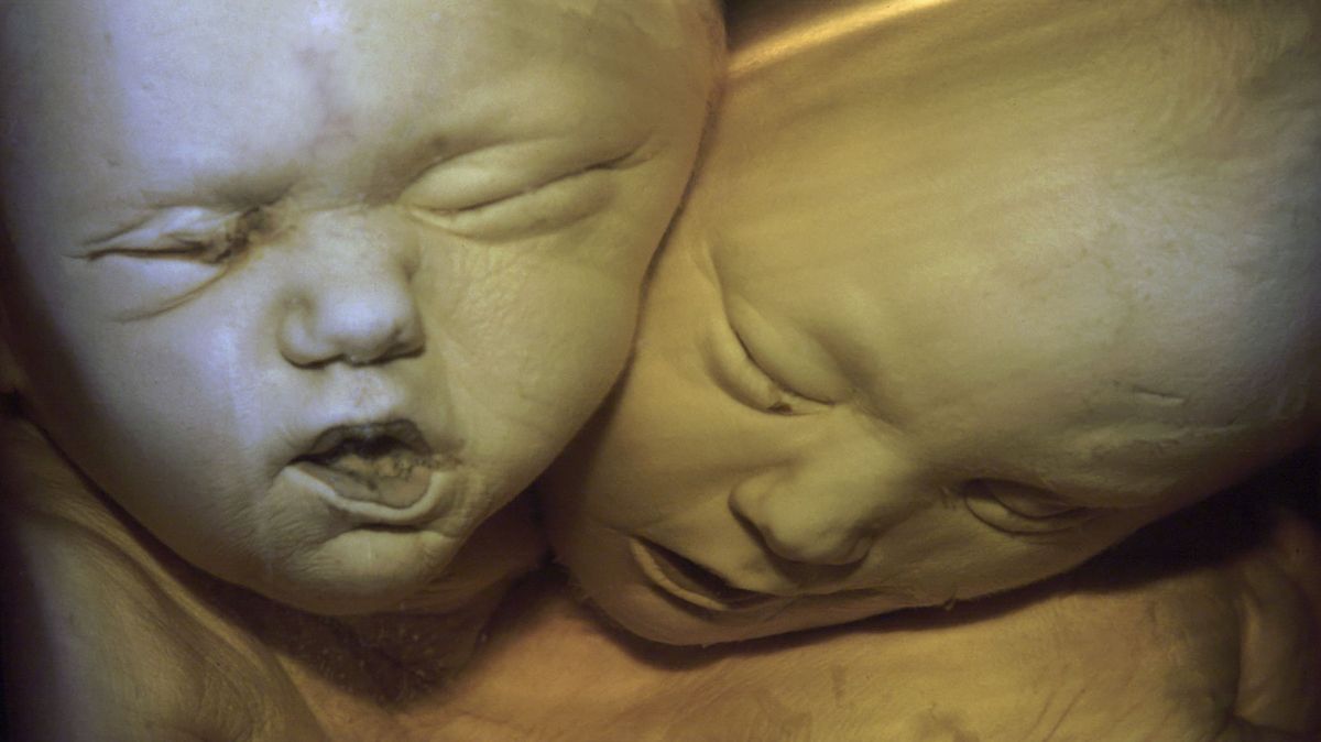 Zemřela nejstarší siamská dvojčata
